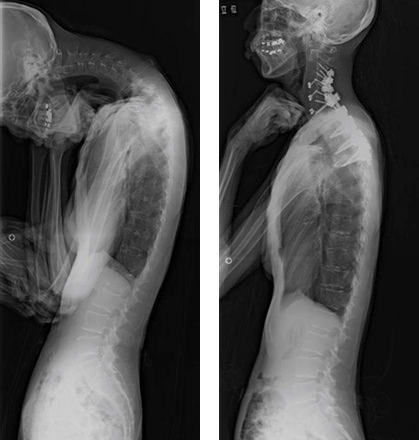 脊柱変形（首下がり）患者の症例写真