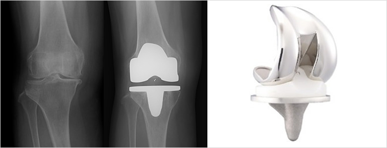 人工膝関節置換術の画像