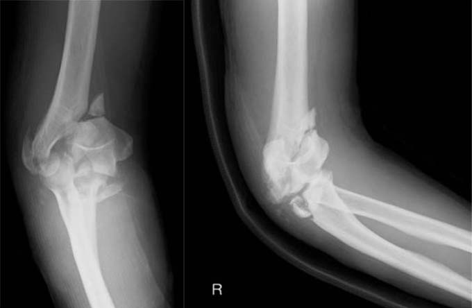 Floating elbow(上腕骨遠位端骨折、尺骨近位端骨折) 受傷時X線単純写真　正面・側面