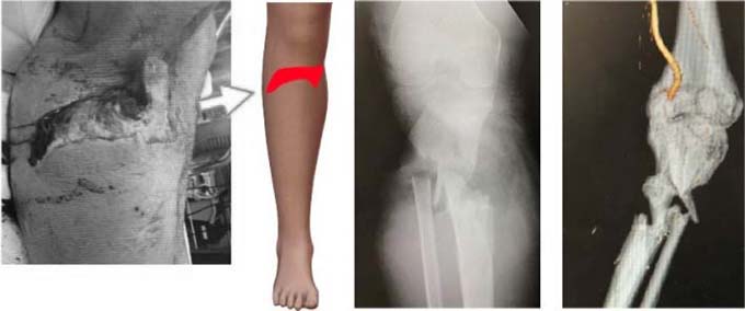 受傷時:脛骨近位端開放骨折、膝窩動脈損傷