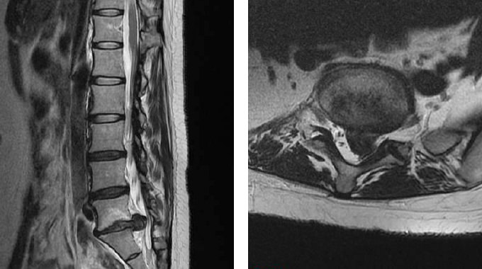 腰椎椎間板ヘルニア患者の症例写真