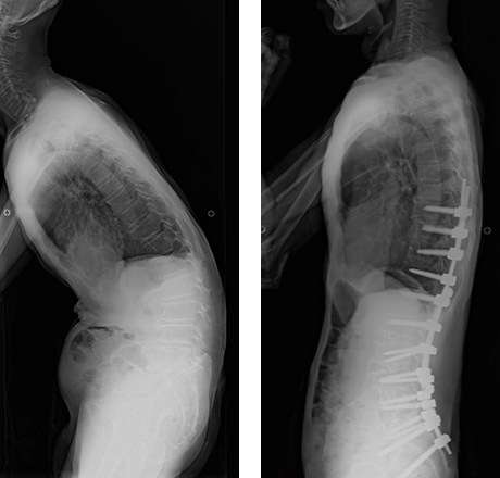 脊柱変形（腰曲り）患者の症例写真