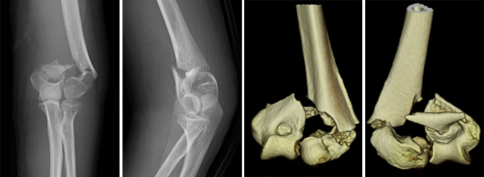 上腕骨遠位端骨折の症例写真