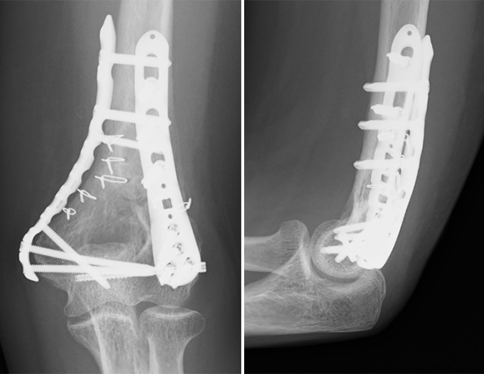 上腕骨遠位端骨折の症例写真