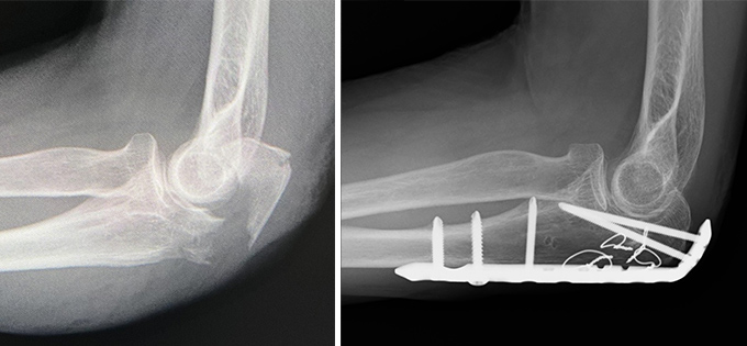 肘頭骨折（プレート固定）の症例写真