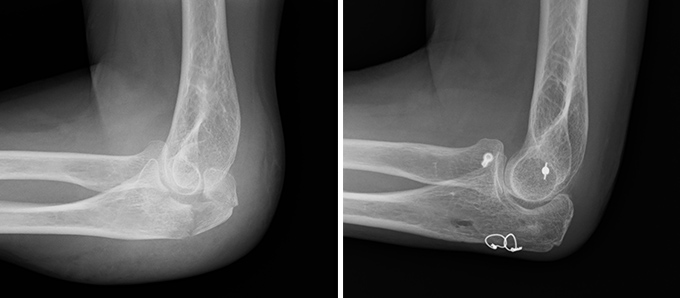 肘頭骨折（dual suture fixation）の症例写真