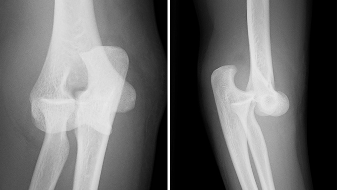 肘関節脱臼の症例写真