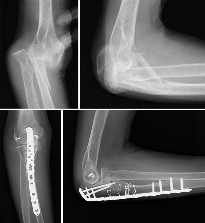 肘関節脱臼骨折の症例写真1