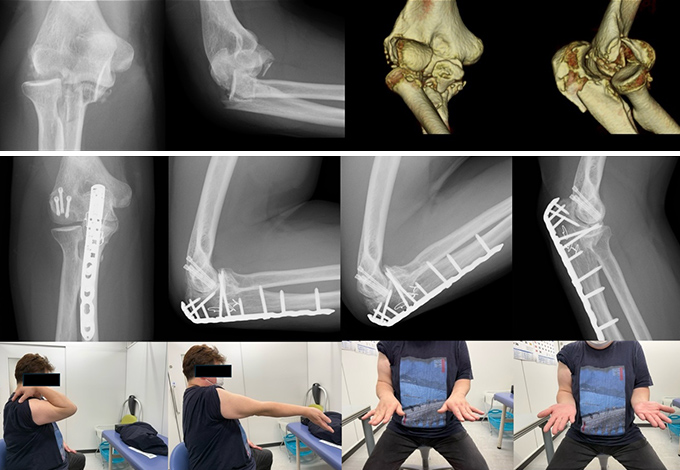 肘関節脱臼骨折の症例写真2