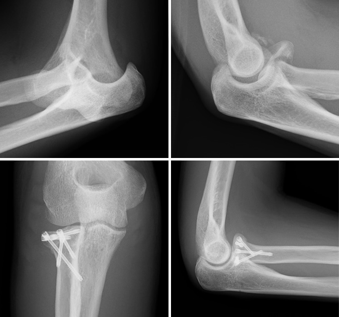 橈骨頭骨折の症例写真