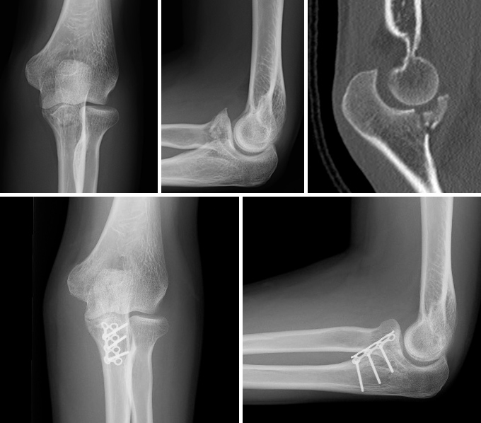 鉤状突起骨折の症例写真