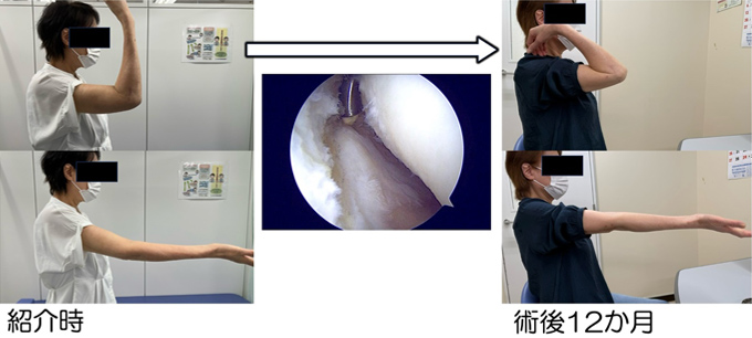 肘関節拘縮の症例写真