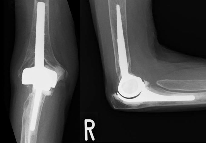 変形性肘関節症の症例写真