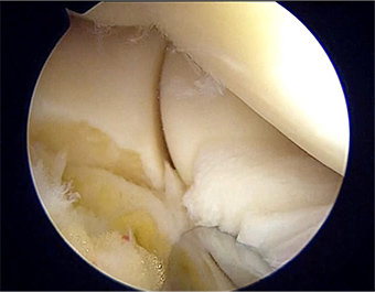 外側上顆炎（テニス肘）の症例写真
