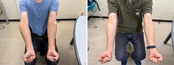 内反肘（上腕骨骨折後変形）の症例写真