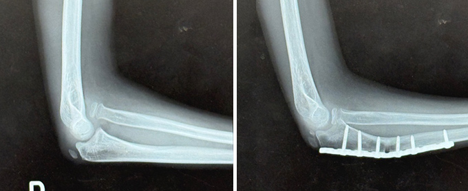 陳旧性モンテジア脱臼骨折の症例写真