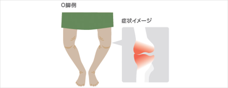 変形性膝関節症のイメージ画像