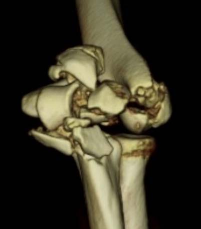 Floating elbow(上腕骨遠位端骨折、尺骨近位端骨折) CT